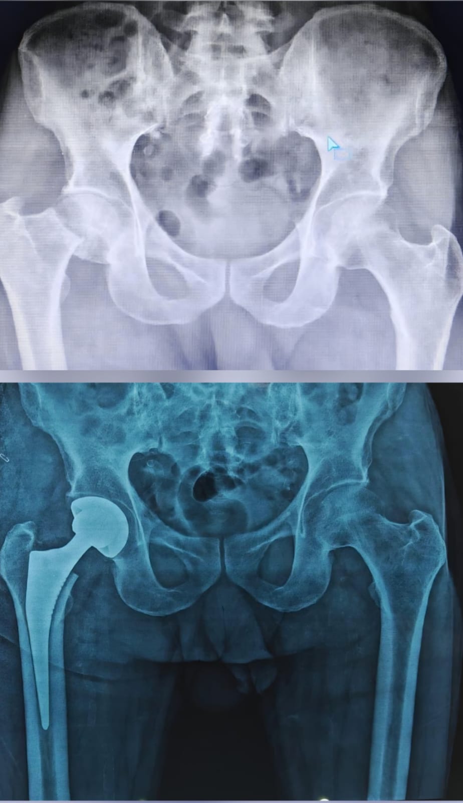 Hip Replacement for neck of femur fracture