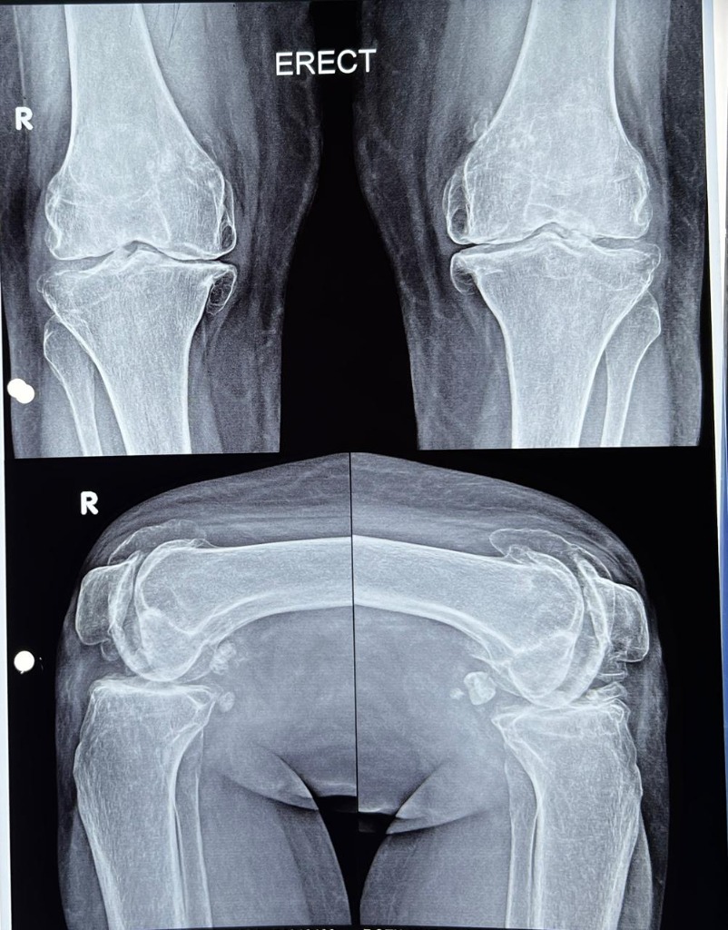 Pre-Op Both Knee Osteo Arthritis X-Ray (Before)